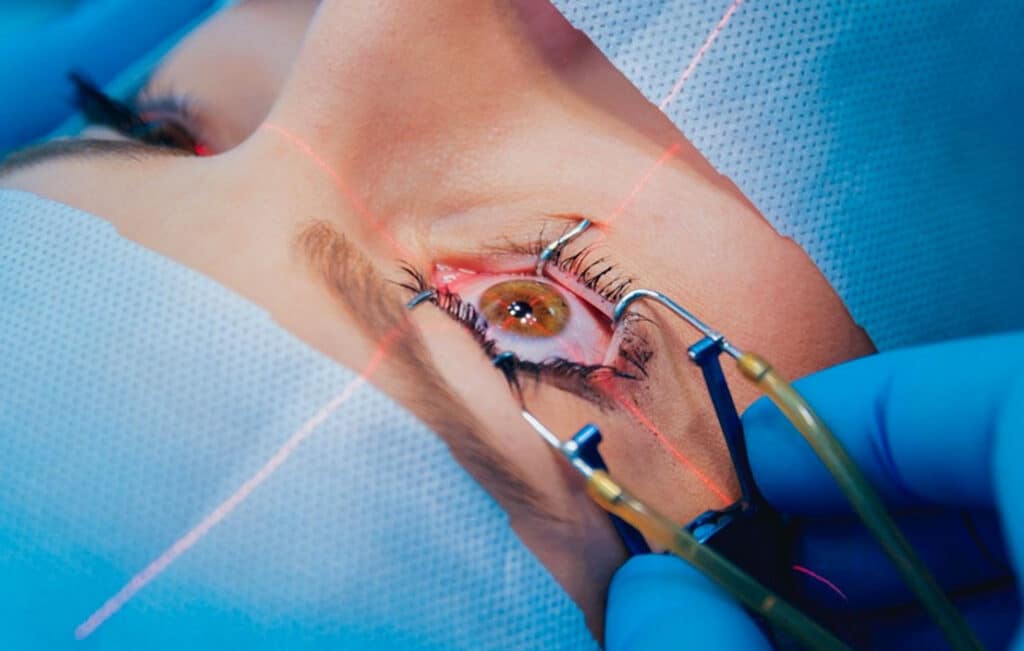 LASIK Surgery