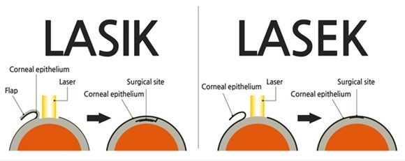 LASEK