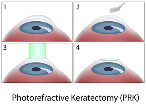 PRK Diagram