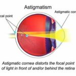 astigmatism diagram