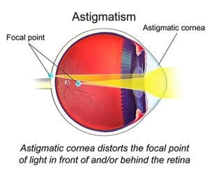 astigmatism diagram