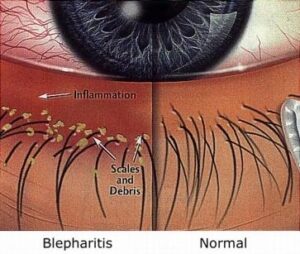 blepharitis vs normal eye 