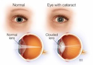 what are cataracts 
