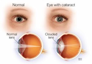what are cataracts