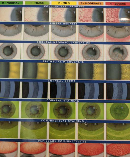 Contact Lens Complications IQ Laser Vision