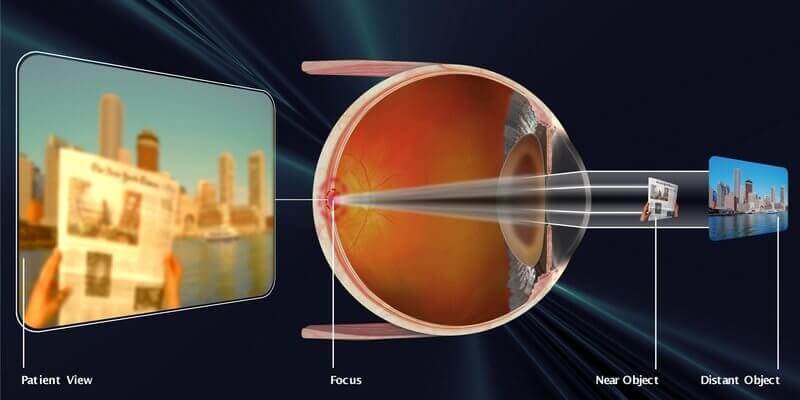 Cataract