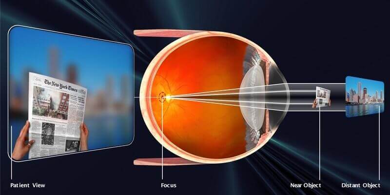 Nearsightedness