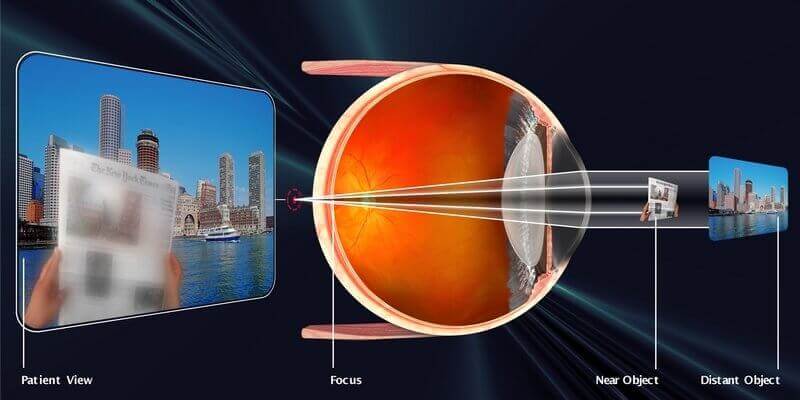 Presbyopia