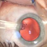 Close Up of Visian ICL Surgery