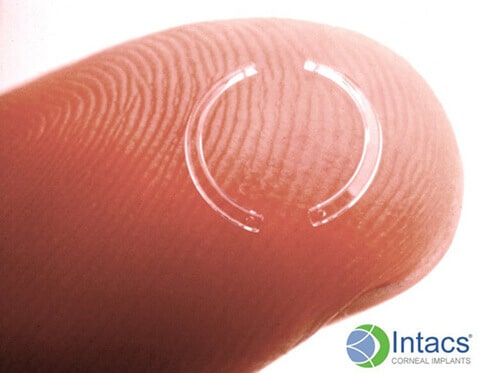 Intacs fingertip