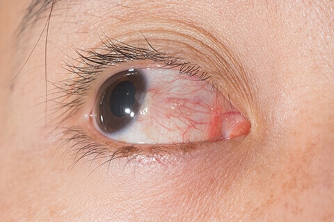 Pterygium close up