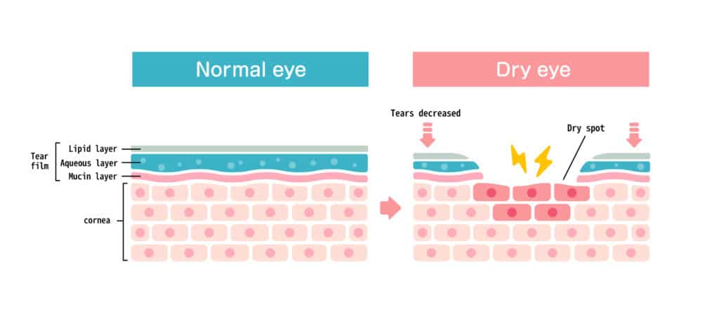 Normal Eye vs Dry Eye graph
