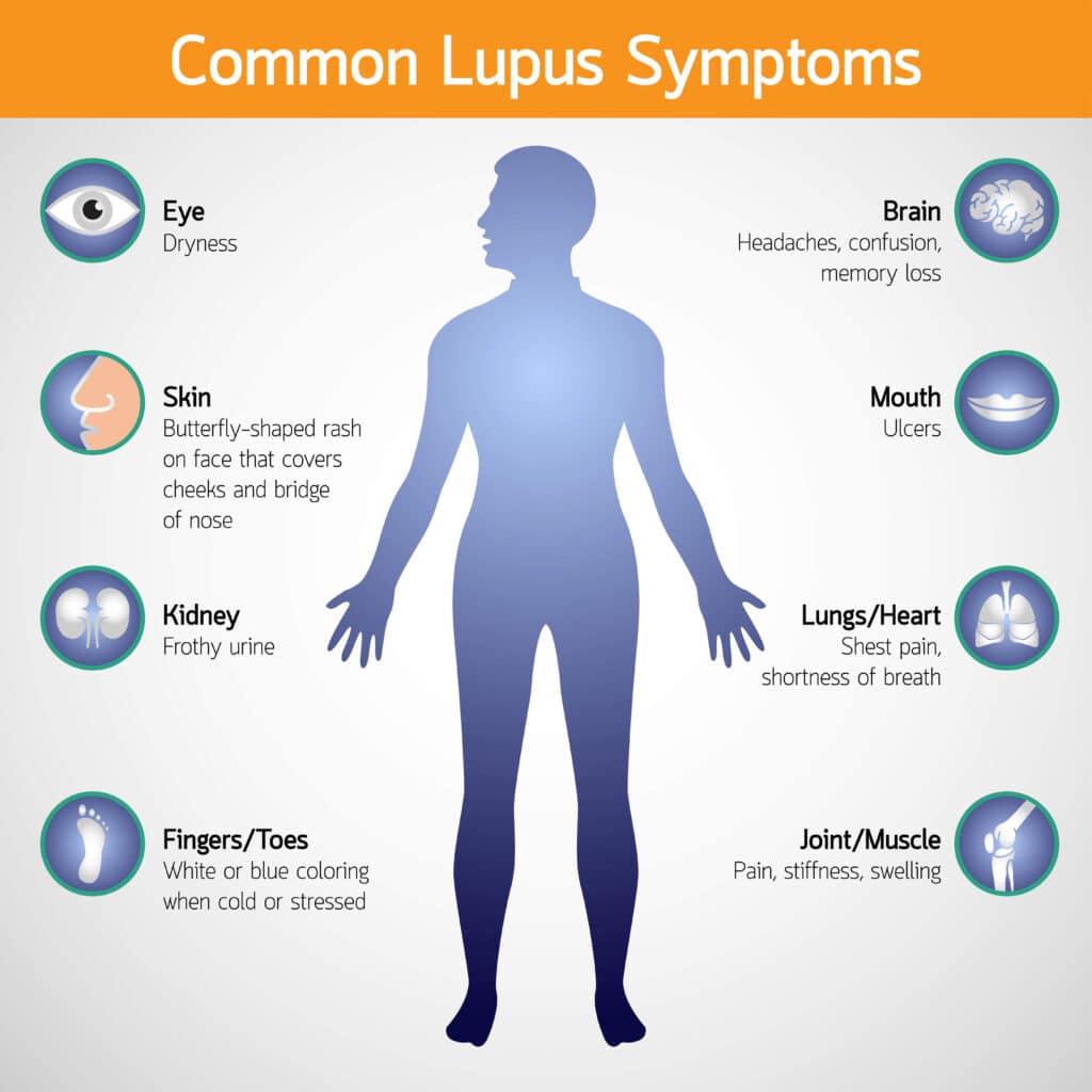 common lupus symptoms 
