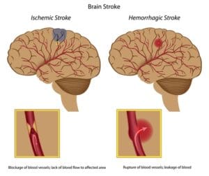 stroke diagram